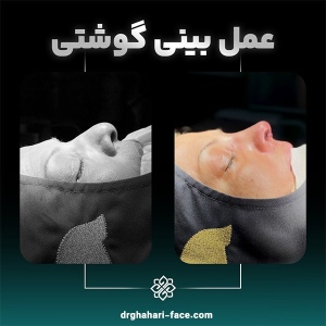 rhinoplasty-1