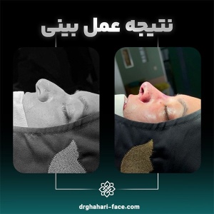 rhinoplasty-3