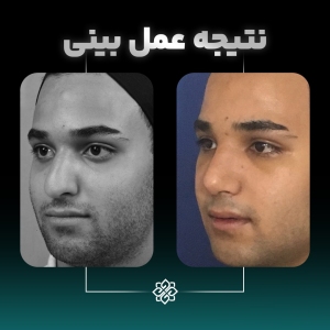 rhinoplasty-4