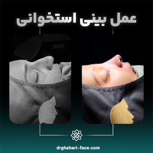 rhinoplasty-5