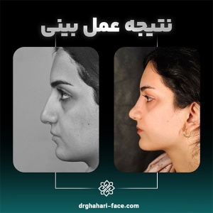 rhinoplasty-6
