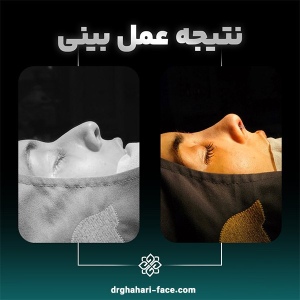 rhinoplasty-7