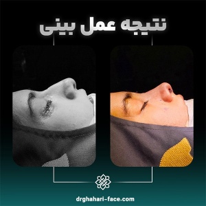 rhinoplasty-8