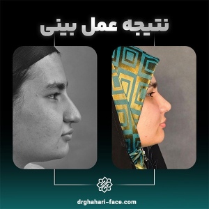 rhinoplasty-9