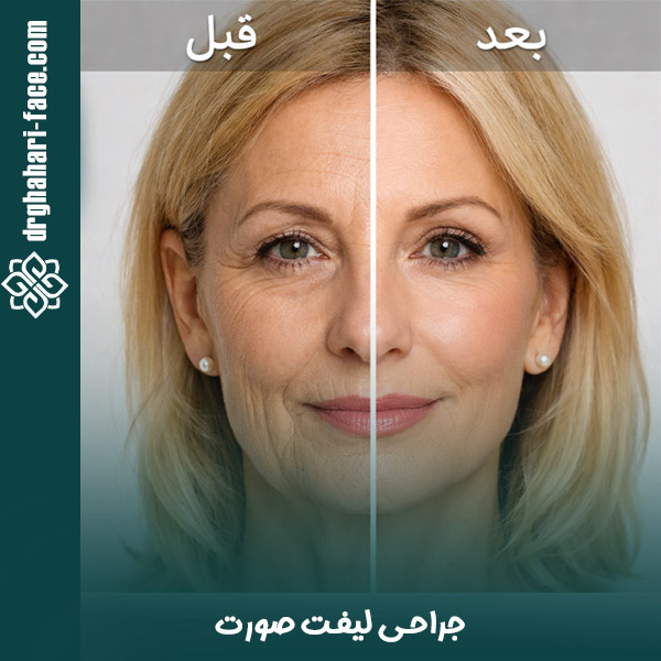 جراحی لیفت صورت - دکتر قهاری