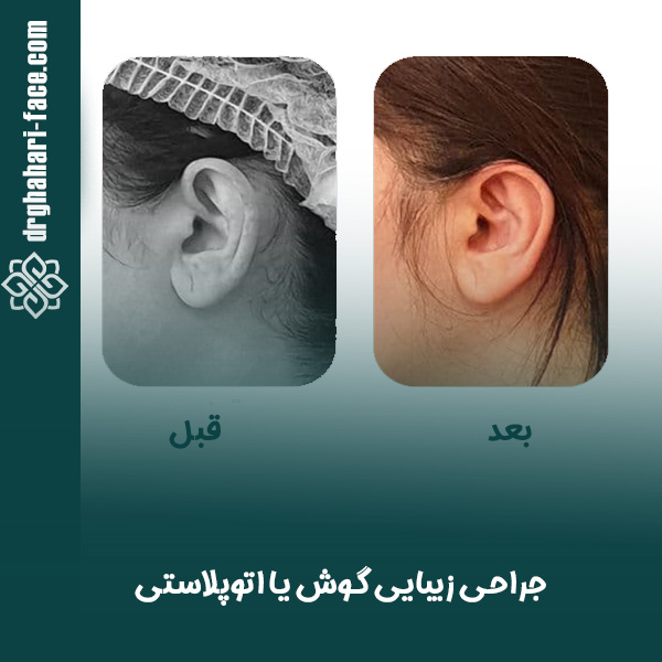 جراحی زیبایی گوش - دکتر حامد قهاری