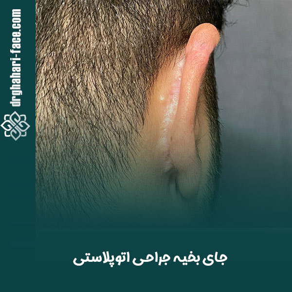 جراحی زیبایی گوش - دکتر حامد قهاری