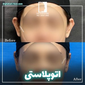 اتوپلاستی - دکتر حامد قهاری