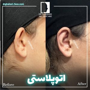 قبا و بعد از جراحی اتوپلاستی - دکتر حامد قهاری