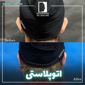 عکس قبل و بعد از جراحی گوش - دکتر حامد قهاری