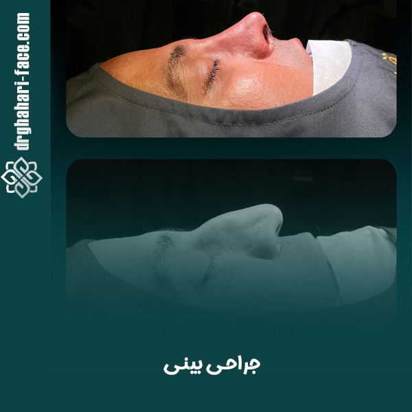 جراحی بینی - دکتر قهاری