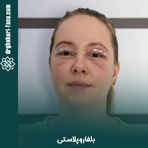 بلفاروپلاستی - دکتر حامد قهاری