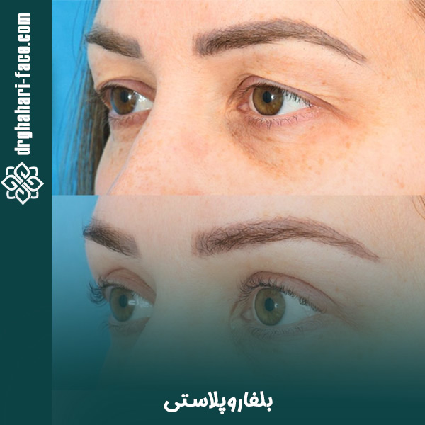 بلفاروپلاستی - دکتر حامد قهاری