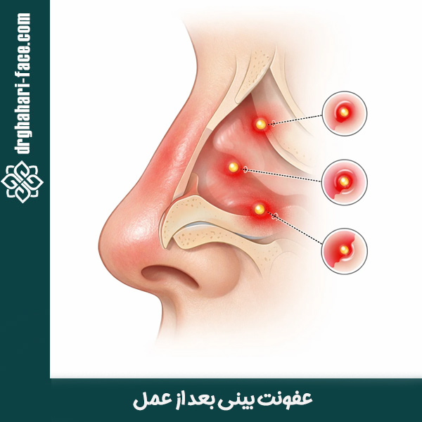 عفونت بینی بعد از عمل - دکتر قهاری