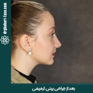 جراحی بینی ترمیمی - دکتر قهاری