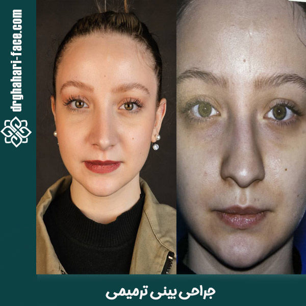 جراحی بینی ترمیمی - دکتر قهاری