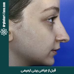 جراحی بینی ترمیمی - دکتر قهاری