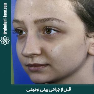 جراحی بینی ترمیمی - دکتر قهاری