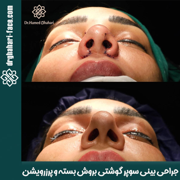 بهترین جراح بینی گوشتی - دکتر قهاری