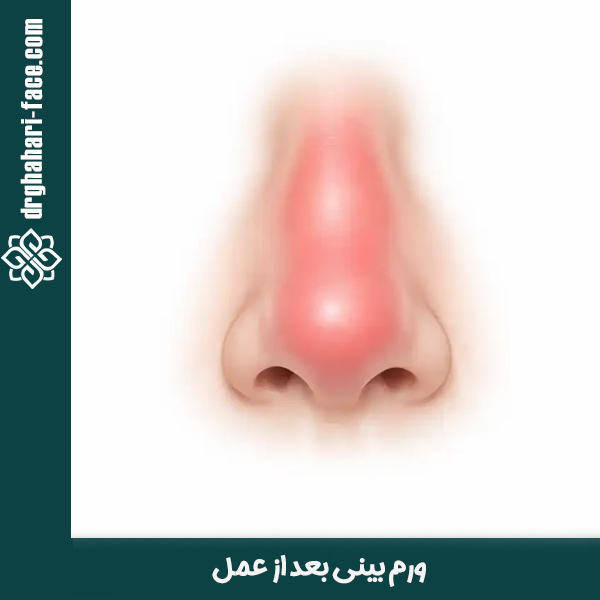 ورم بینی بعد از عمل - دکتر قهاری