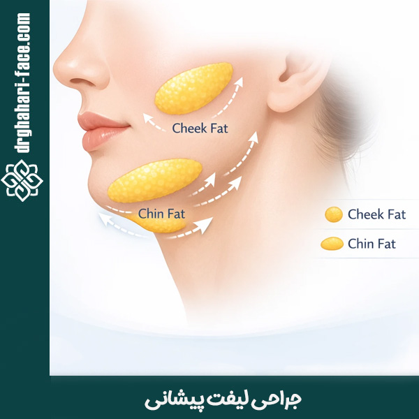 لیپوساکشن غبغب و گونه - دکتر قهاری