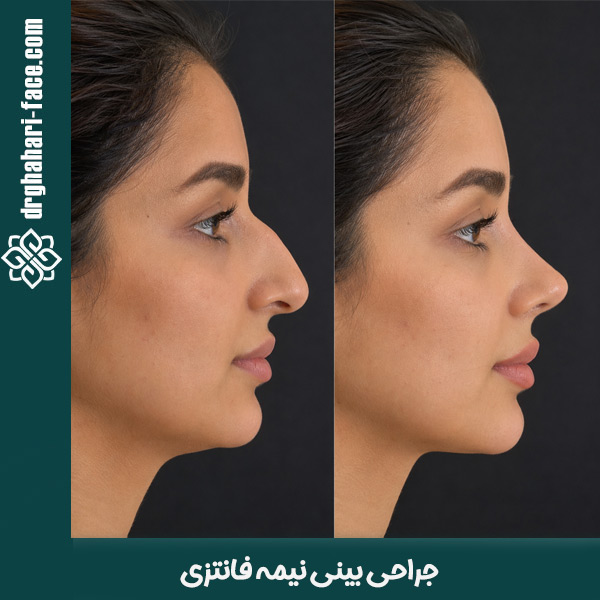 جراحی بینی نیمه فانتزی - دکنر قهاری