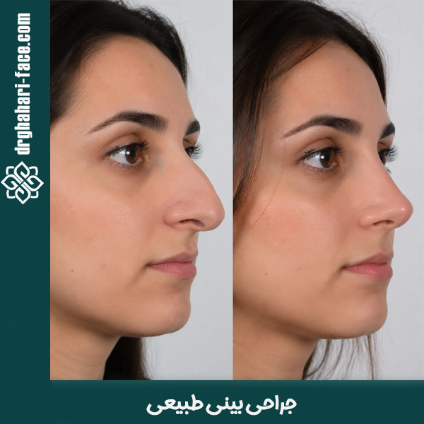 جراحی بینی طبیعی - دکتر قهاری
