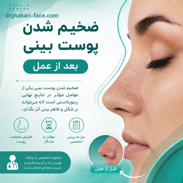 ضخیم شدن پوست بینی بعد از عمل - دکتر حامد قهاری
