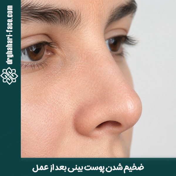 ضخیم شدن پوست بینی بعد از عمل - دکتر حامد قهاری